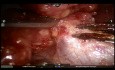 Mediastinal Lesion