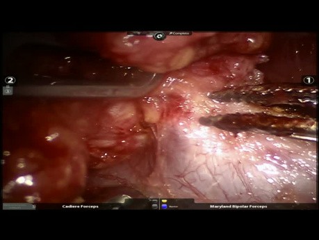 Mediastinal Lesion