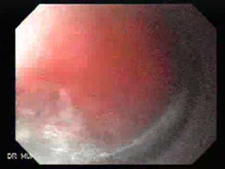 Dieulafoy´s Lesion (Exulceratio Simplex) (4 of 9)