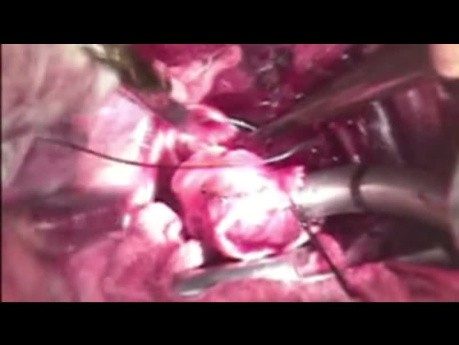 Off Pump Tracheal Reconstruction