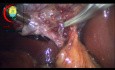 Dissection of Cystic Duct Below Rouvier Sulcus and Attacking the Cystic Duct Branch of the Cystic Artery