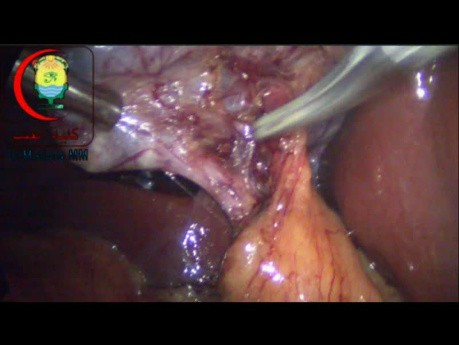 Dissection of Cystic Duct Below Rouvier Sulcus and Attacking the Cystic Duct Branch of the Cystic Artery