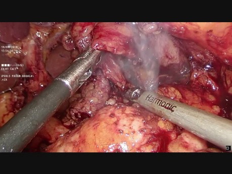 Lap D2 Total Gastrectomy 