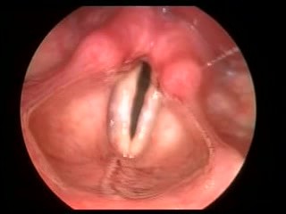 Paradoxical Movement Of Vocal Cords