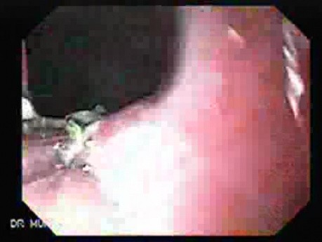 Hiatus Hernia (3 of 3)