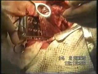 Lobectomy - Lung Cancer Surgery
