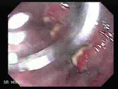 Esophageal Squamous Cell Carcinoma - Visualization of the Lesion