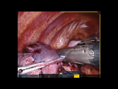 Complex Case of a Lonely Metastase Treated by Robotic Lingulectomy and Basilectomy
