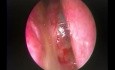 Posterior Nasal Septal Cholesterol Cyst - Endoscopic Removal
