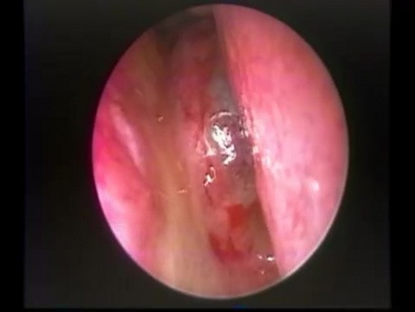 Posterior Nasal Septal Cholesterol Cyst - Endoscopic Removal