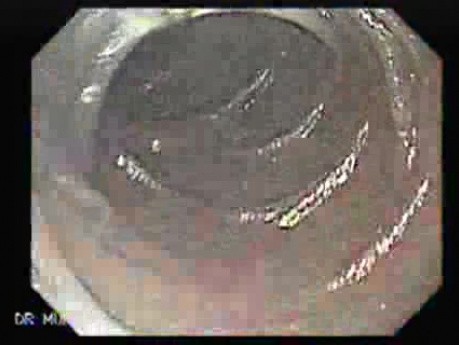 Angiodysplasia of the Duodenum (3 of 4)