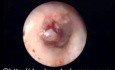 Haemorrhagic Bullous Myringitis