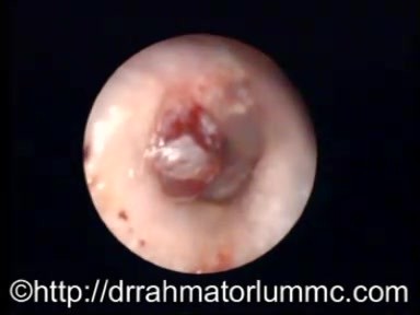 Haemorrhagic Bullous Myringitis