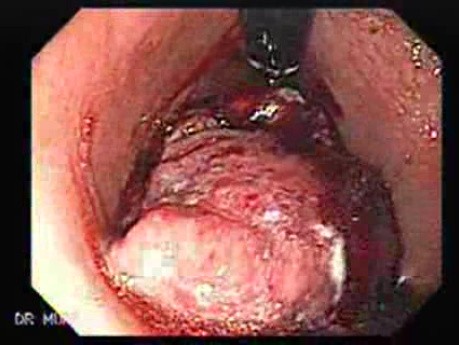 Adenocarcinoma of the Corpus and Fundus (2 of 4)
