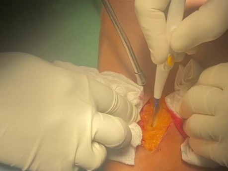 Minimally Invasive Surgery in Bacterial Endocarditis