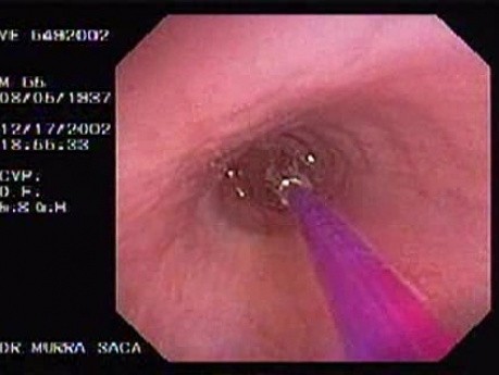 Zollinger- Ellison Syndrome - Gastric Ulcer with Gastrocolic Fistula (15 of 21)