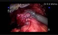 Sleeve Gastrectomy Leak and Convertion to Roux-en-Y Gastric Bypass