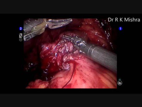 Sleeve Gastrectomy Leak and Convertion to Roux-en-Y Gastric Bypass
