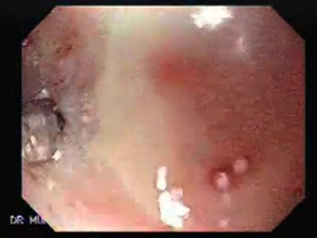 Stenosis of the esophagus caused by radiotherapy with cobalt to a carcinoma (2 of 2 )