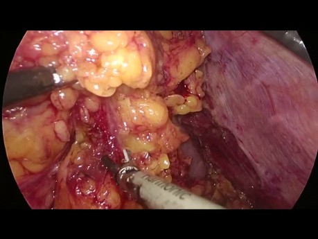 Totally Laparoscopic Gastrectomy in an Obese Patient with Gastric Cancer