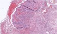 Appendix- Acute Appendicitis- Self-Leraning Module – Cell Injury And Inflammation 2