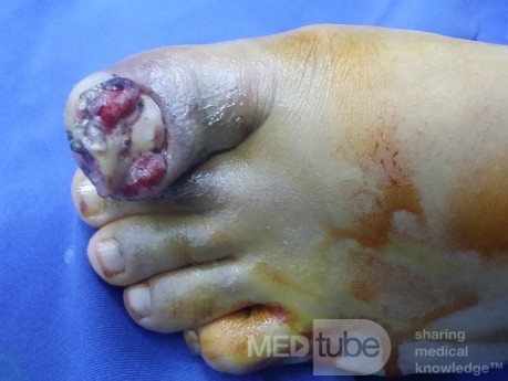 Ingrowing Big Toe Nail with Hallux Valgus