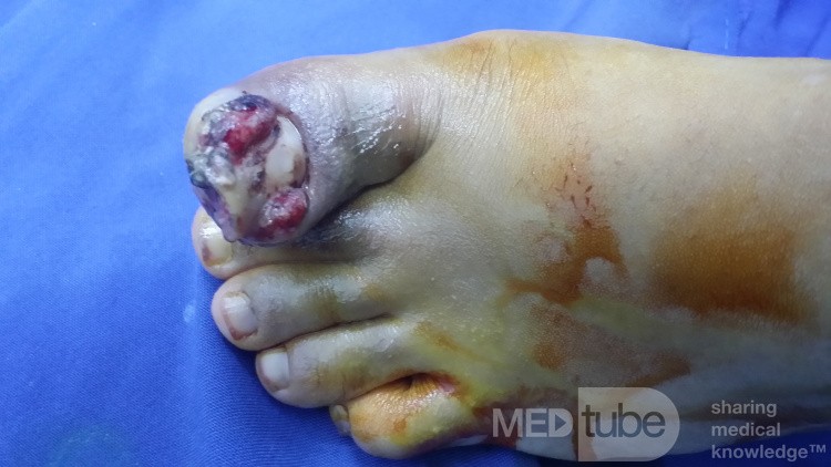 Ingrowing Big Toe Nail with Hallux Valgus