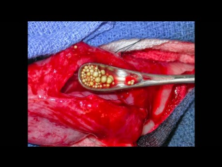 Cystostomy
