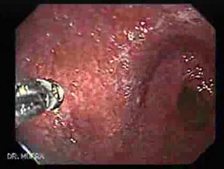 Adenocarcinoma of the Cardia and Fundus with Signet Ring Cells (3 of 5)