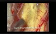 Spinal Cord Tumor - Cervical Intramedullary - Microsurgical removal