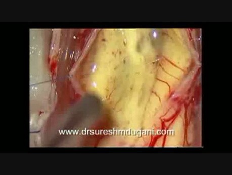 Spinal Cord Tumor - Cervical Intramedullary - Microsurgical removal