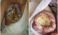 Locally Advanced Breast Cancer