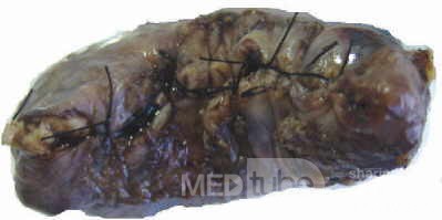Gallbladder Adenocarcinoma and litiasis (1 of 13)