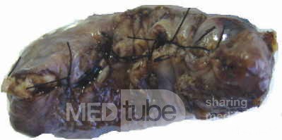 Gallbladder Adenocarcinoma and litiasis (1 of 13)