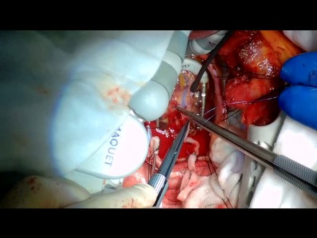 Redo Off-Pump Coronary Bypass Surgery via Left Thoracotomy