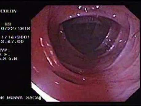 Diverticular Disease - Hemorrhage (12 of 15)