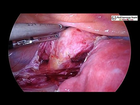 Total Laparoscopic Hysterectomy and Bilateral Salpingectomy with Ureteric Mapping using ICG
