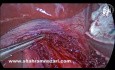 Achalasia Treatment: Laparoscopic Heller Myotomy and Dor Fonduplication