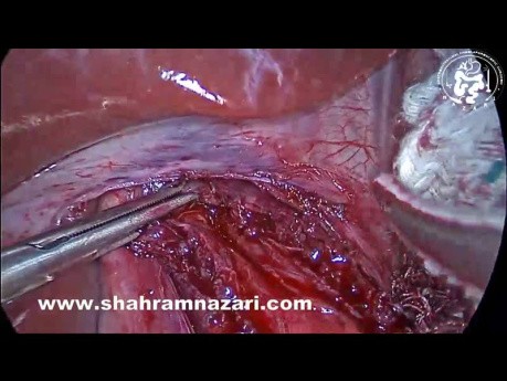 Achalasia Treatment: Laparoscopic Heller Myotomy and Dor Fonduplication