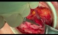 Open Inguinal Hernia Repair