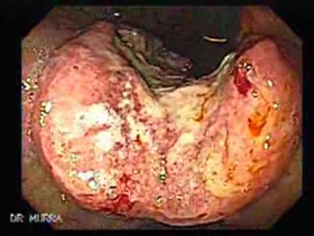 Gastric Adenocarcinoma With Varices - Endoscopy (4 of 8)
