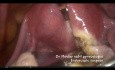 Standart laparoscopic polymyomectomy (Type 6 and 7 myomas )