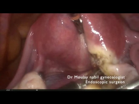 Standart laparoscopic polymyomectomy (Type 6 and 7 myomas )