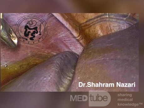 Accessory Grooves on the Diaphragmatic Surface of the Liver