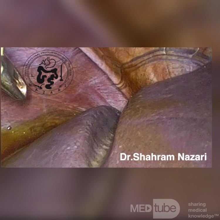 Accessory Grooves on the Diaphragmatic Surface of the Liver
