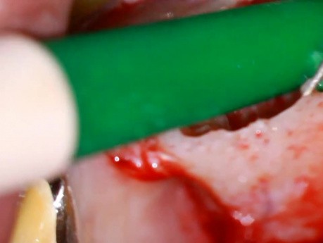 Maxillary Molar Microsurgery
