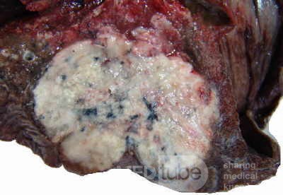 Lung Adenocarcinoma (1 of 5)
