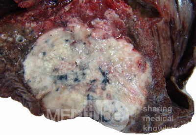 Lung Adenocarcinoma (1 of 5)