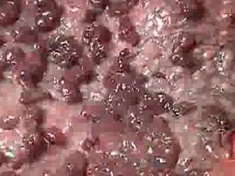 Multiple Rectal Ulcers (61 of 110)