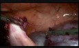 Minilaparoscopic Surgery for Wwo Large Pelvic Cysts